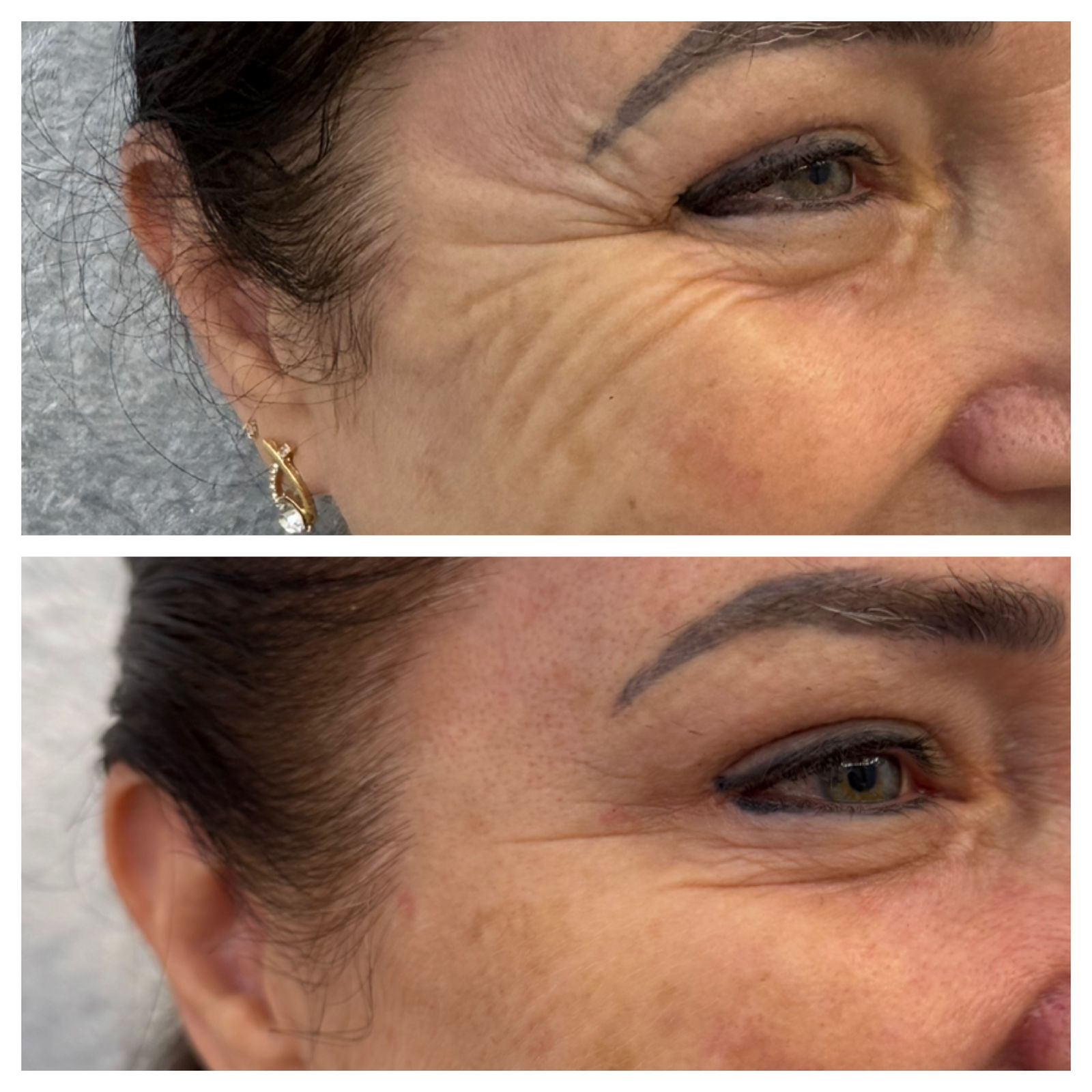 Resultado Antes e Depois