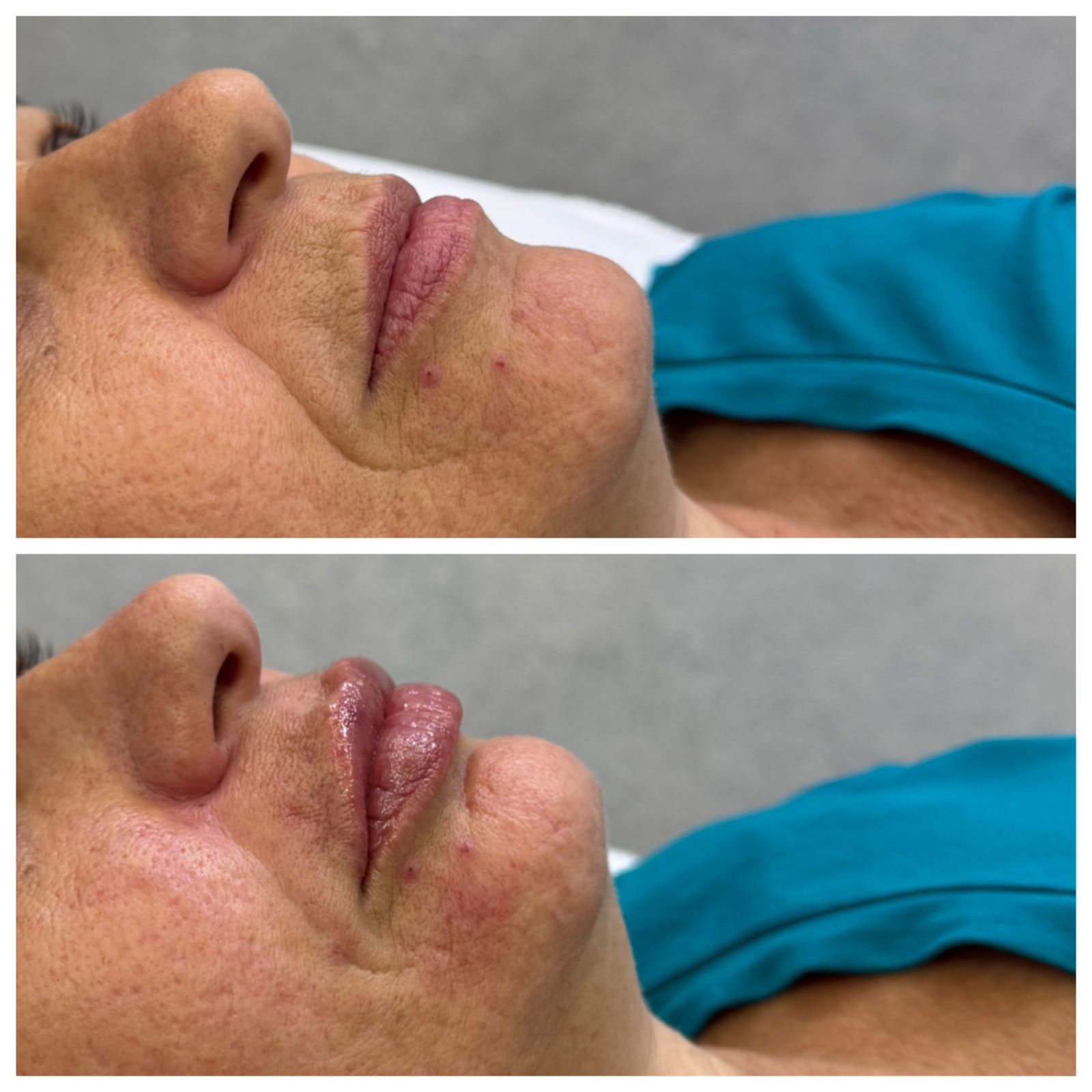 Resultado Antes e Depois